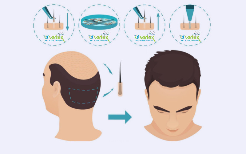 Hair Transplant in Delhi